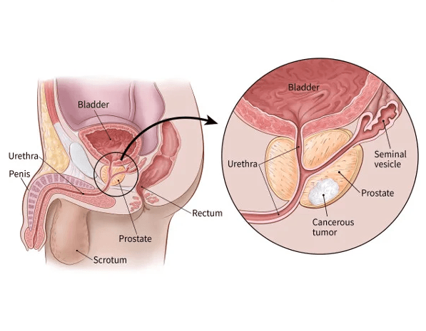 Prostate Cancer Treatment