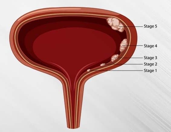 Bladder Cancer Treatment